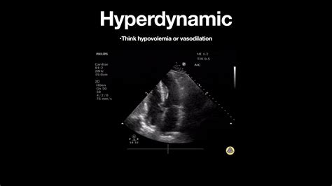 left ventricular systolic function is hyperdynamic